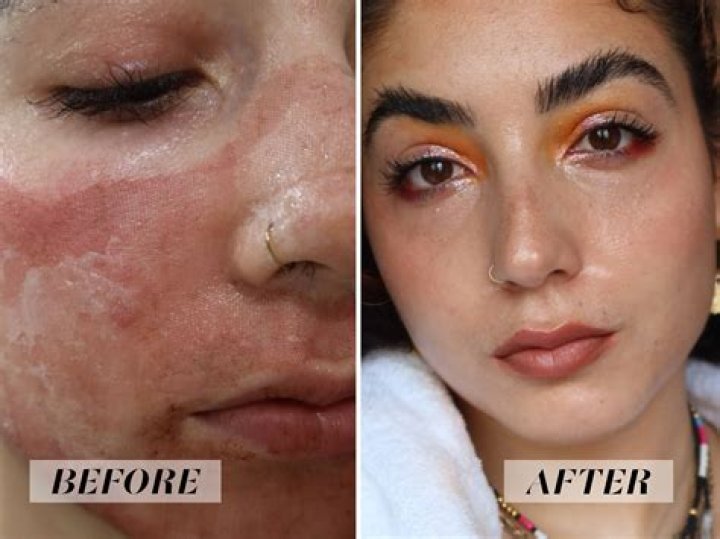 Before & After photographs following Enerjet procedure for Stretchmarks