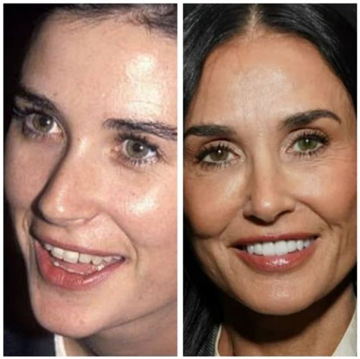 Demi Moore Smile Makeover Dental makeover, Smile makeover, Celebrity