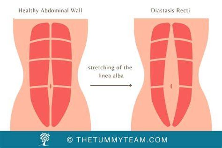 Does Running Hold The Key To Healing Diastasis Recti?
