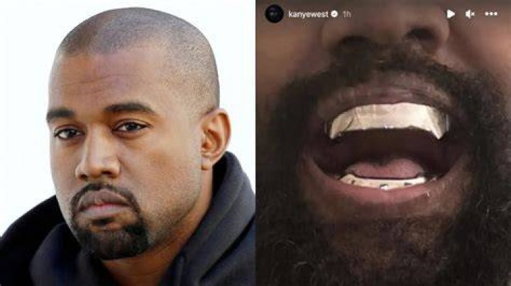 Kanye West replaced his teeth with 850k James Bondinspired Titanium